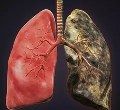 bad-lungs_759_getty.jpg