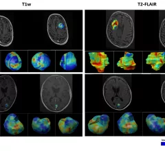 York University researchers demonstrate how AI can help predict brain metastasis outcomes