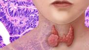 thyroid_cancer_26990475791.jpg