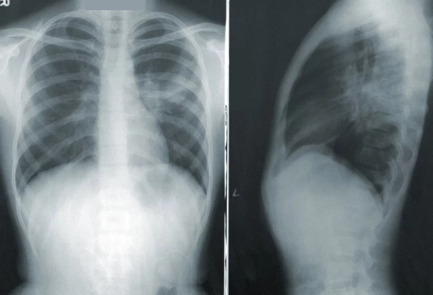 Chest X-ray. Using an explainable artificial intelligence (AI) model, researchers were recently able to accomplish highly accurate labeling on large datasets of publicly available chest radiograph X-rays.. 