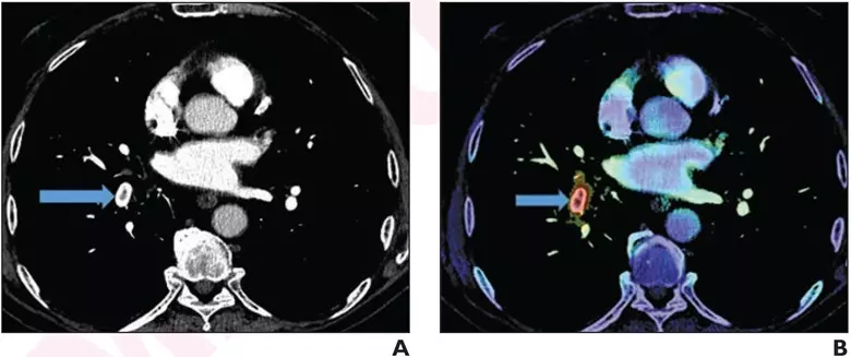 pulmonary embolism on CT pulmonary angiography