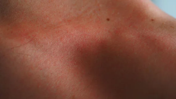 Sunburn