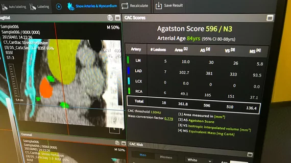 An example of artificial intelligence automated coronary artery calcium scoring shown by Coreline at ACC23. The AI also identifies and color codes the anatomy so help show the reviewing radiologist or cardiac imager what and where things were calculated. #ACC #ACC23